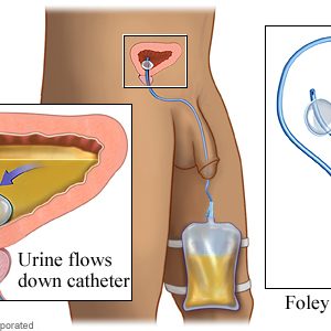 vesical-catheterization-bexiga-1