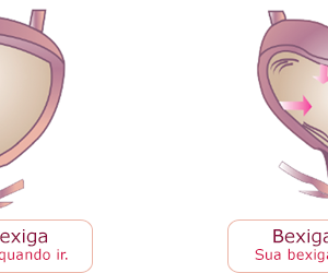imagem-bexiga-hiperativa