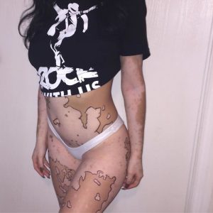 vitiligo-body-art-map-ashley-soto-16-58ca440ce526f__700