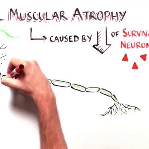 Spinraza Nusinersena ame
