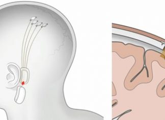 ELON MUSK ANUNCIA NEURALINK, SENSORES CEREBRAIS PARA CONTROLAR DISPOSITIVOS – TECMUNDO